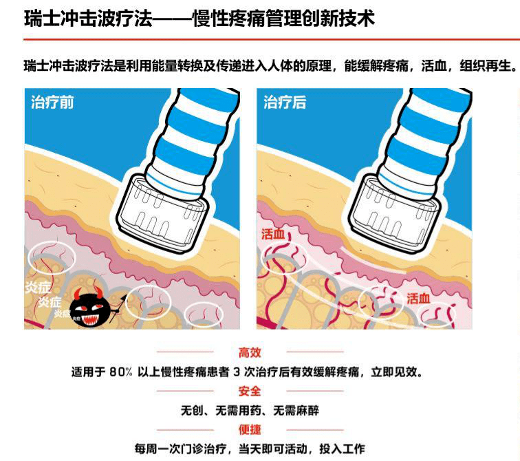 冲击波|疼痛是“病”！冲击波系统让您治“痛”无忧！