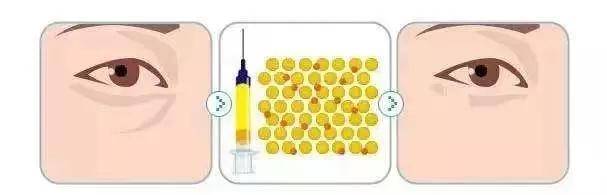 玛吉磨皮滤镜都去不掉的泪沟，还有救么？