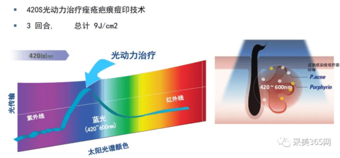 脂肪采美机构开业推荐:韩国Jeisys再希思SmoothCool冰柔极光-高性价比的光子嫩肤仪