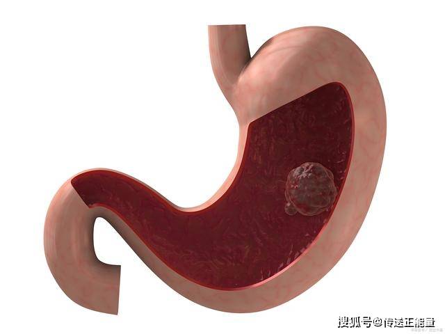 胸骨|胃癌早期,身体先知!若能尽早发现,对于患者来说是好事
