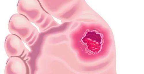 控制|皮肤是血糖的“晴雨表”，皮肤有4种表现，就是让你控糖的信号