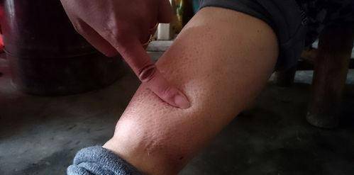 症状|你知道''尿毒症''吗？日常生活中我们应注意什么，本文或为您解答