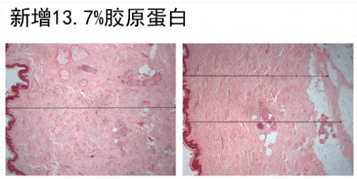 脂肪双下巴消失仅用3天，钻石超塑是怎么做到的？