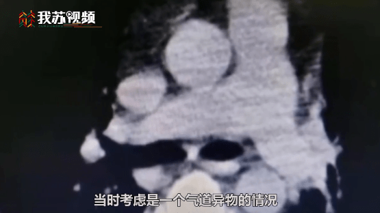 海姆|警惕！一男子含着话梅睡觉 话梅核卡进气道险丧命