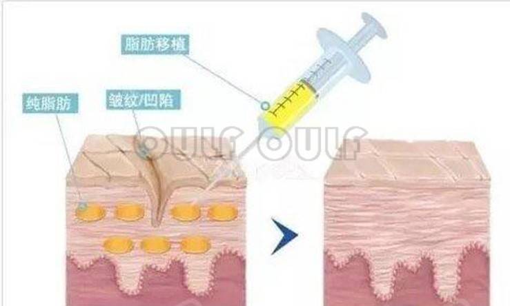 脸部脂肪填充脸部多少钱左右，脸部脂肪填充一般多少钱的费用？