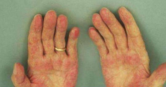 因为|肝脏不好皮肤先知,专家提醒:皮肤出现以下症状,肝或已稀烂