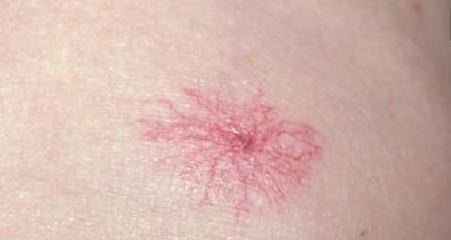 因为|肝脏不好皮肤先知,专家提醒:皮肤出现以下症状,肝或已稀烂