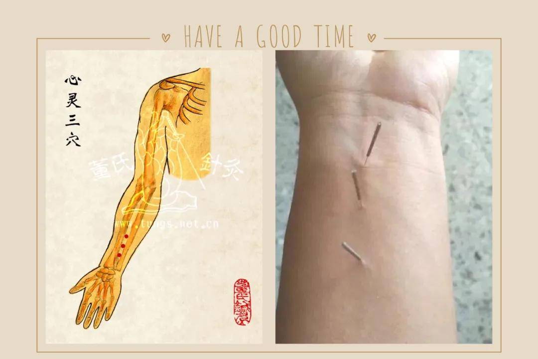 世界董氏针灸第二代嫡系传人郑承浚博士病症处方咽炎