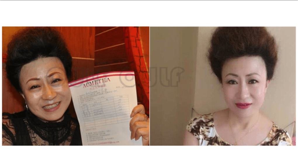 存活率做完脂肪填充后遗症 下垂咋回事~