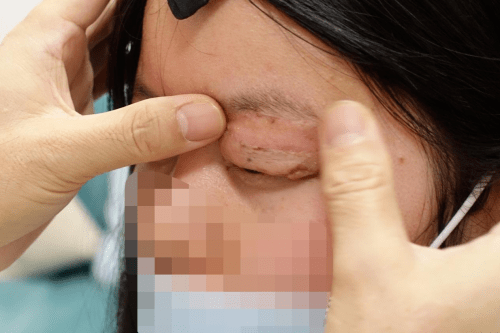 双眼皮|西安国际医学整形医院王爱武修复眼球外露六年眼睑缺损患者