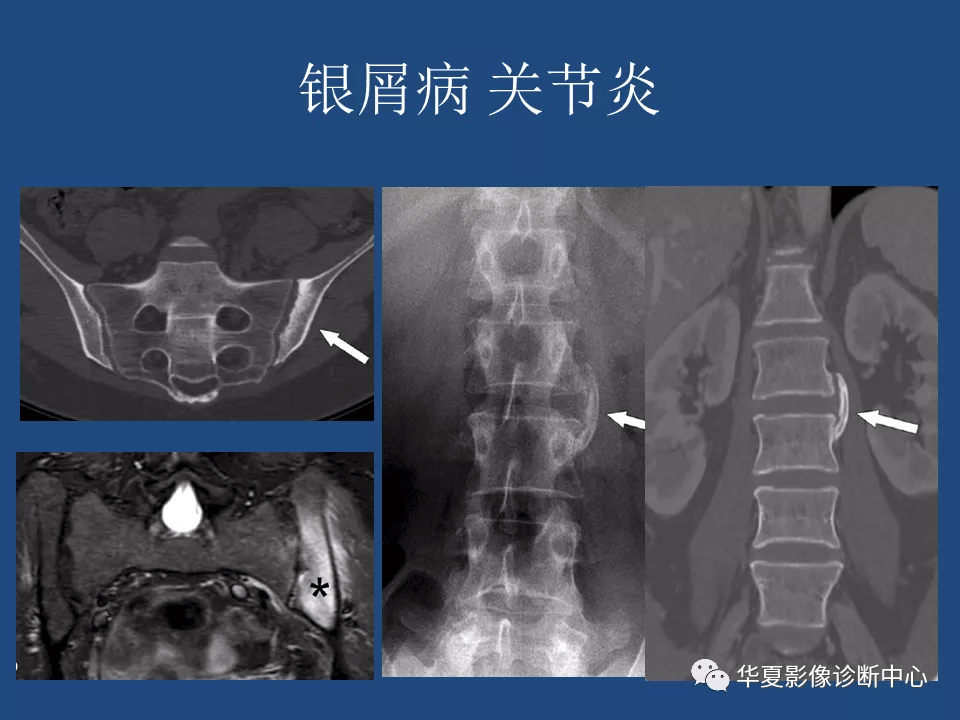 强直性脊柱炎影像诊断和鉴别诊断