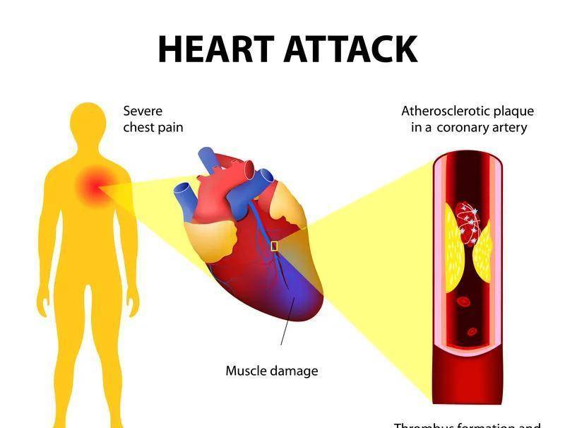 他汀|血脂高了该如何选择“他汀”,怎样选可以避开副作用?医生讲清楚