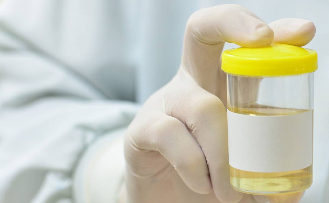 相关|尿检查出潜血而且有3个加号,是什么原因?今天,来告诉各位答案