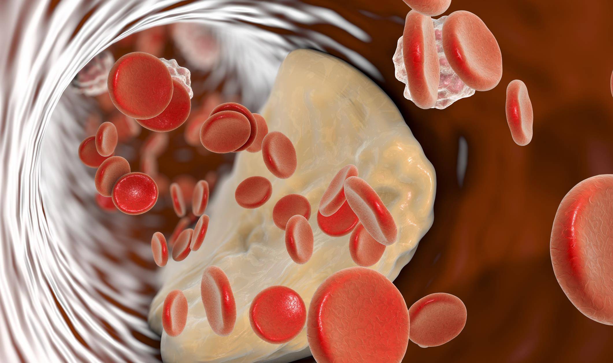 水平|血脂高了，吃阿托伐他汀还是瑞舒伐他汀，哪个副作用小？