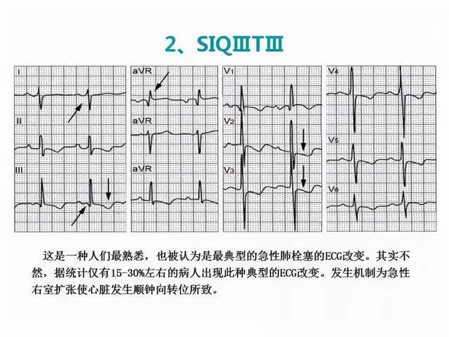 我让他把心电图发给我,一看心电图心率一分钟100次,心电图显示s1q3t3.