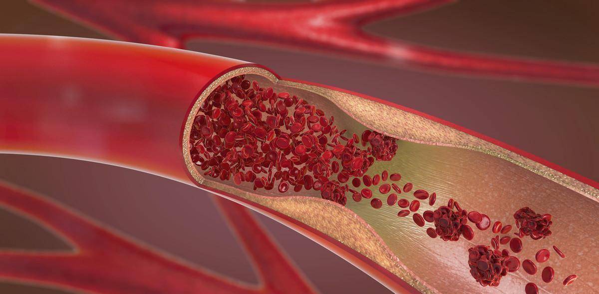血管|主动脉弓钙化的患者，与遗传无关，常会有胸闷气短的症状