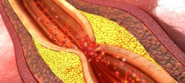 他汀|我对那个动脉有斑块的人说，最好不要停用他汀，原因是什么？