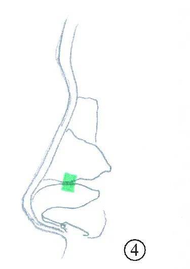 手术|如何do鼻子才能有好的效果？