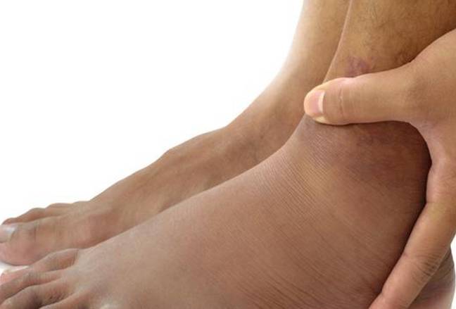 症状|医生忠告：尿酸高的人除腰疼外有这“3种表现”，是肾在求救！