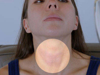 女性甲状腺的前兆图片