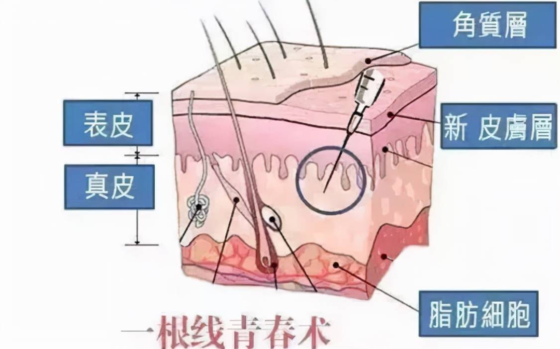 面部埋线和脂肪填充冲突吗？哪些人不适合做线雕？适合自己最重要~