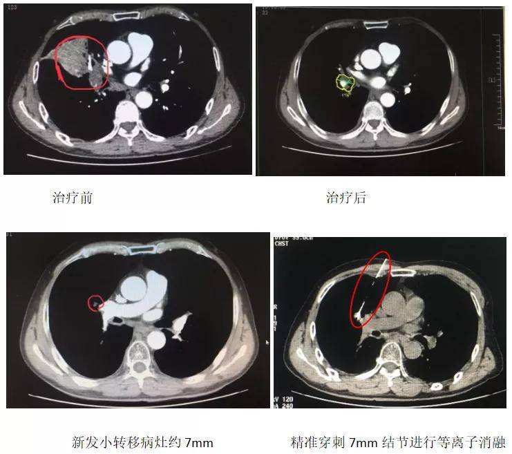 胸科医院|治疗肺内恶性小结节“金刚钻” 西安市胸科医院开展首例CT引导下等离子消融术