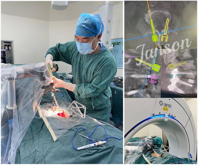 首例|西北首例！O臂结合“天玑”机器人CBT置钉为高龄患者实施腰椎翻修