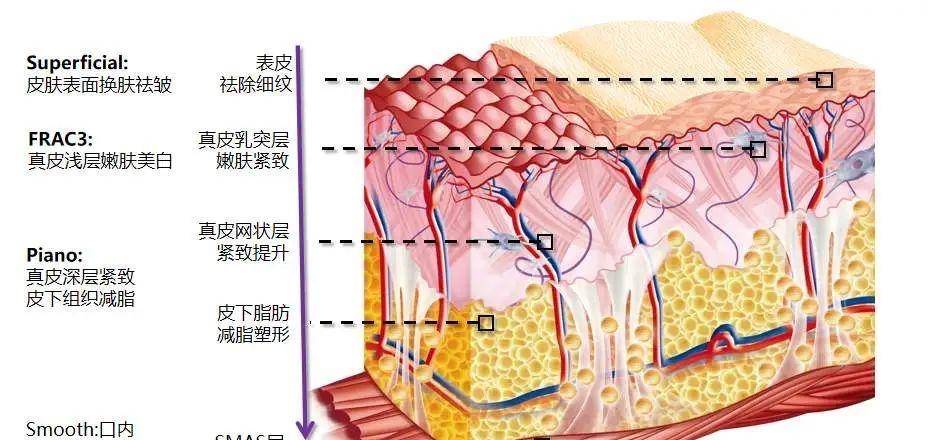 治疗钟丽缇都在做的fotona4d效果如何？