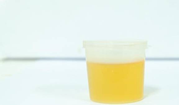 尿酸|排尿时候哪些表现，说明尿酸“越线”了？留意这3种