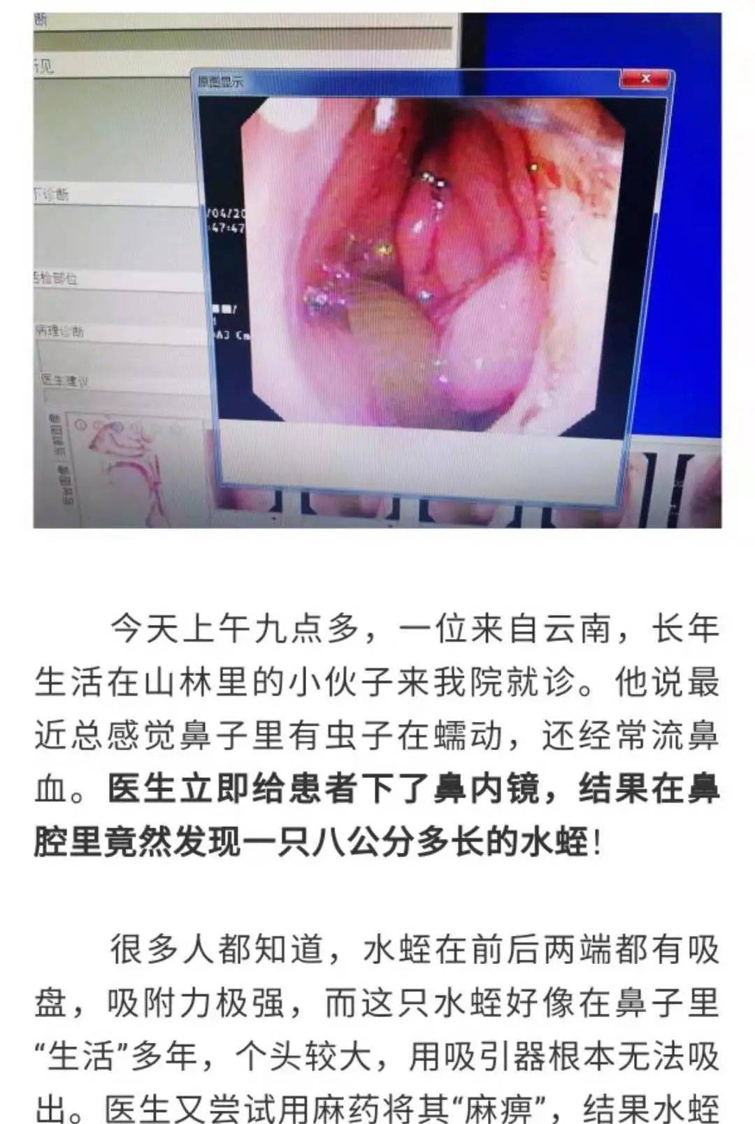 损伤|成都民生耳鼻喉医院提示：别把「涕中带血」不当回事