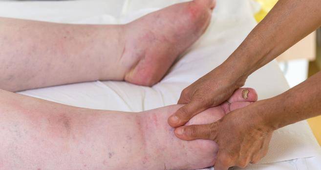 IgA肾病是什么病 5d92c4be2d7e44b19a6d394d4b27ecdf.jpeg