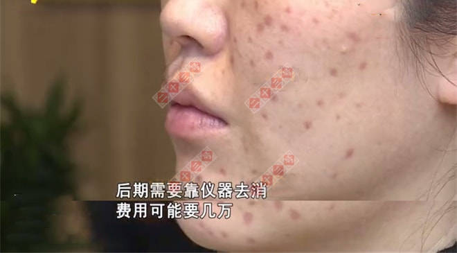 女士女子花一万五祛斑多一脸印子，提出退钱被拒，店家负责人：我没收费！