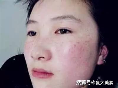 眼睛复大美素：要祛斑，这些色斑面诊原理你要懂！