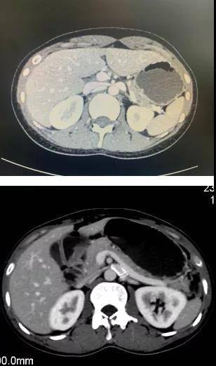 综合征|血尿腰痛？胡桃夹综合征了解一下！