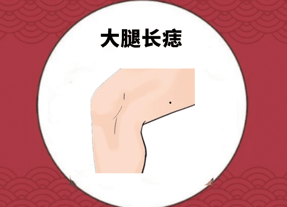 大腿長痣