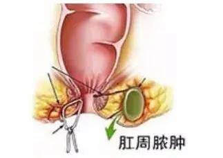 丨肛肠科医生丨都是 痔疮 惹的祸 肛门