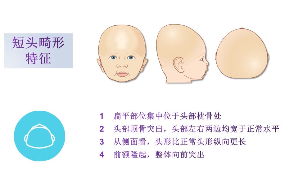 婴儿头颅畸形症状有哪些