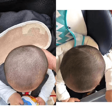 新生儿最全头颅扫描介绍