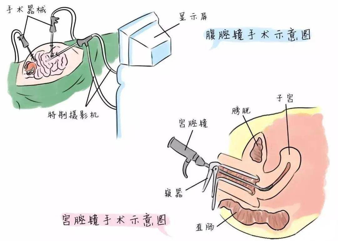 妇女开腹手术全过程图片