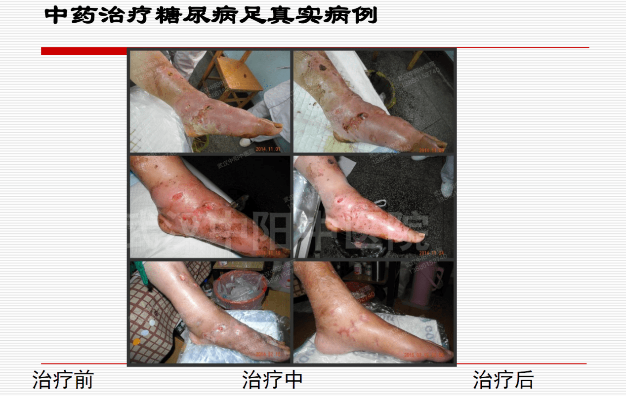 内调|65岁糖尿病足婆婆险截肢？武汉中阳中药生肌液祛腐生肌，促进创面愈合
