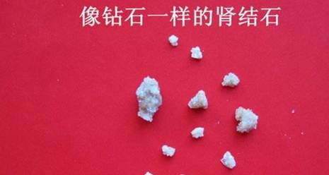 肾脏|重视治疗是将结石疾病危害降到最低的最有效方式