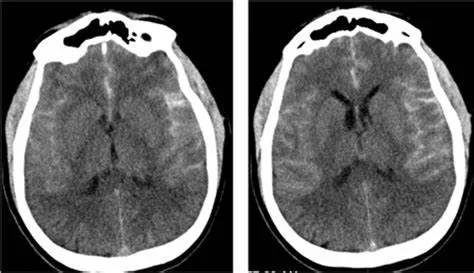 蛛網膜下腔出血:大腦縱裂池及雙側外側裂池可見高密度影,灰白質分界