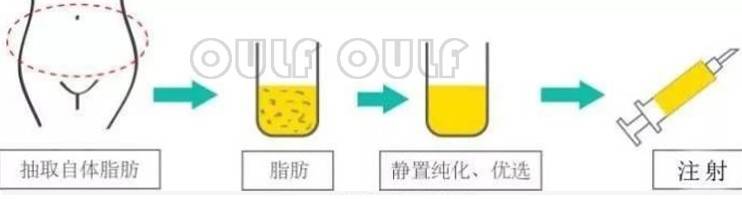 脸部脂肪填充全脸当天照片?脸部脂肪填充恢复过程太艰难了!