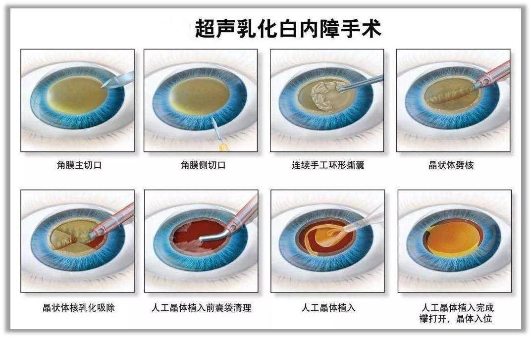 并通过眼表的微小切口将其吸取出来(白内障超声乳化摘除),然后在