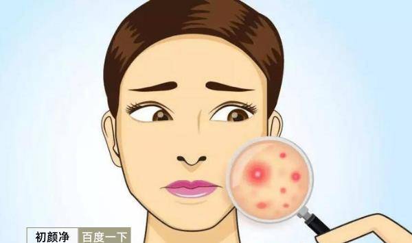 补充作为痘肌！这10点你一定得知道！