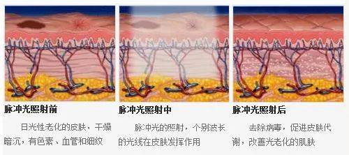 国货医美界也有“国货之光”，多效无痛的国产光子你知道吗~