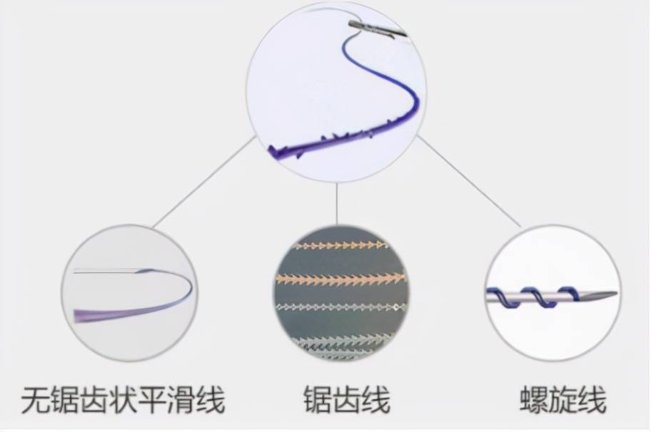 进行皮肤科专家：埋线提升面部几天恢复？埋线可以维持几年？必看~