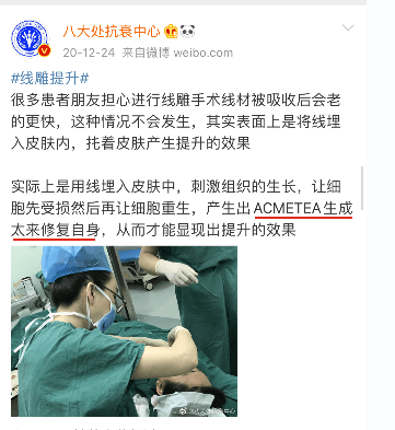 时间ACMETE：大v线雕能维持多久？大v线雕一般用几根线？越多越好？