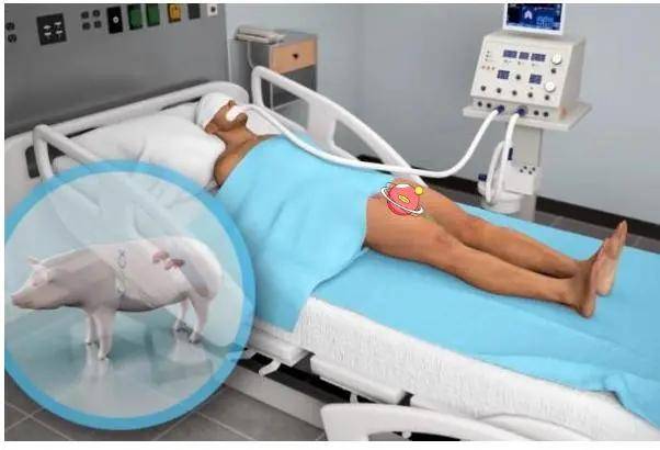 人体手术|世界首例！猪肾脏移植人体手术成功，3天均未发生排异反应