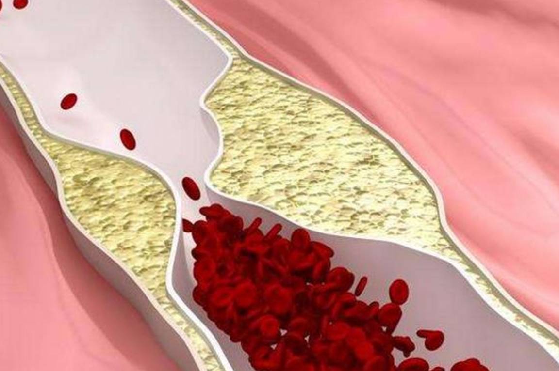 血液粘稠,早起可能会有这3个表现,常做2事,清血管,防血栓!_身体
